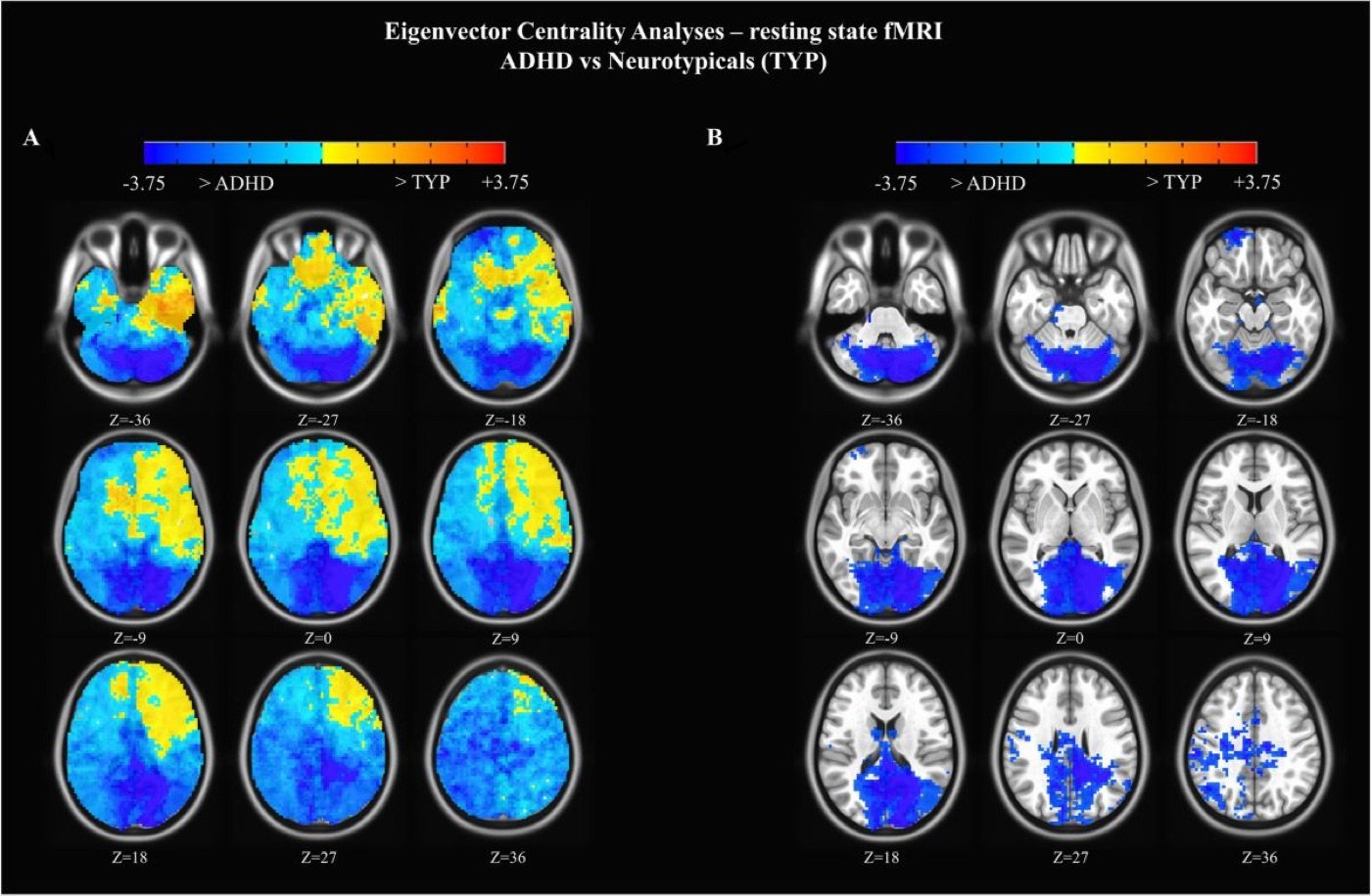 fMRI eigenvector-centrality figures comparing ADHD and neurotypical brains